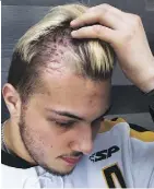  ?? KAYLE NEIS ?? Kaleb Dahlgren shows the scars he received as a result of the Humboldt Broncos bus crash.