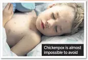  ??  ?? Chickenpox is almost impossible to avoid