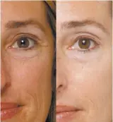  ??  ?? Before and After from 4-Week Study Above. Remarkably, these results were achieved using a special form of marine collagen found in Eslor Collagen Day Cream, not Botox ® or any other skin tightening treatment. The cosmetic is a quarter of the cost.