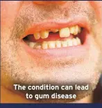  ?? ?? The condition can lead
to gum disease