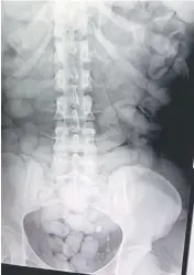  ?? — AFP photo ?? Picture shows the X-ray of the woman with small packages of cocaine in her stomach.