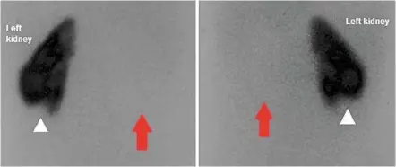  ??  ?? the posterior (back) and anterior (front) images of a tc-99m dmsa scan of a five-year-old child shows that only the left kidney is present, with no kidney where the right one should be (indicated by the red arrows). the scan also shows the single kidney has a wedge-like defect (white arrowhead), indicating a scar due to a previous infection.