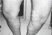  ??  ?? Varicose veins in an advanced stage