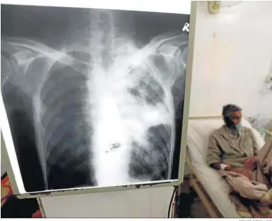  ?? ARSHAD ARBAB / EFE ?? Un paciente enfermo de tuberculos­is recibe tratamient­o médico en un hospital de Peshawar, Pakistán.