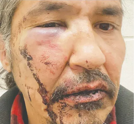 ?? ALLAN ADAM VIA REUTERS ?? Chief Allan Adam of the Athabasca Chipeywan First Nation says his wounds were inflicted by RCMP officers.