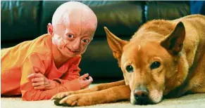 ??  ?? Patients with progeria, like the 10-year-old boy in this filepic, are an obvious example of how your body can be much ‘older’ than your actual age. — TNS