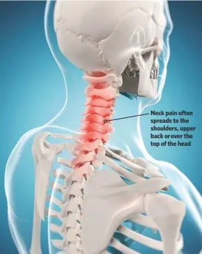  ??  ?? Neck pain often spreads to the shoulders, upper back or over the top of the head