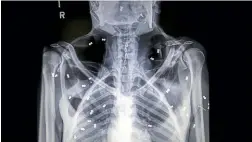  ?? AP ?? An X-ray image shows air rifle pellets inside the body of a female orangutan named Hope.