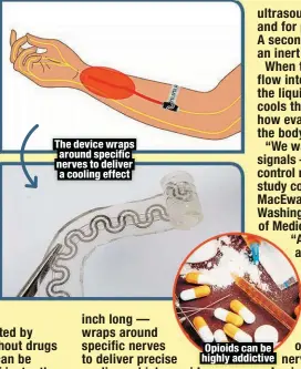  ?? ?? The device wraps around specific nerves to deliver a cooling effect
Opioids can be highly addictive