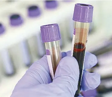  ??  ?? Liquid biopsy uses blood from a patient to collect a sample of cancer cells or parts of DNA.