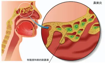  ??  ?? 有黏液和脓的副鼻窦鼻­窦炎