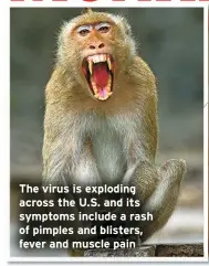  ?? ?? The virus is exploding across the U.S. and its symptoms include a rash of pimples and blisters, fever and muscle pain