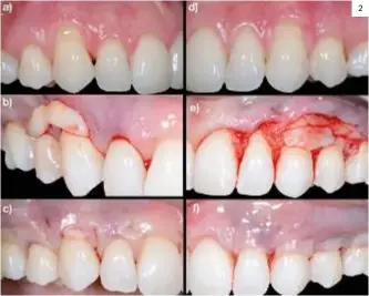  ??  ?? Imagen 2. a) Situación basal de 13. b) Ubicación del injerto en la posición en la que se va a introducir mediante técnica túnel. c) Sutura del injerto. d) Situación basal de 23. e) Ubicación del injerto en la posición que se va a suturar combinado con la técnica de avance coronal. f) Sutura del injerto y del colgajo. 2