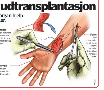  ??  ?? Gassbind
En steril kompress beskytter mens huden fester seg og nytt blodomløp etableres. Donorhud Donorhuden legges over det skadde området. Sying
Små hudområder sys på, mens
større områder faktisk kan stiftes på
plass.