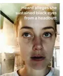  ??  ?? Heard alleges she sustained black eyes
from a headbutt