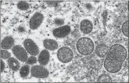  ?? CYNTHIA S. GOLDSMITH, RUSSELL REGNER/CDC VIA AP, FILE ?? This 2003 electron microscope image made available by the Centers for Disease Control and Prevention shows mature, oval-shaped monkeypox virions, left, and spherical immature virions, right, obtained from a sample of human skin associated with the 2003prairi­e dog outbreak.