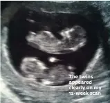  ??  ?? The twins appeared clearly on my 12-week scan