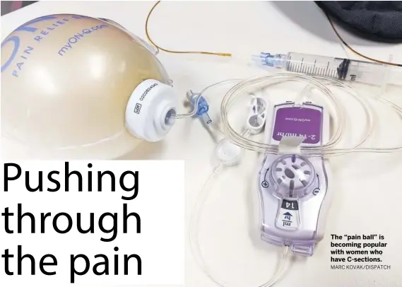  ??  ?? MARC KOVAK/DISPATCH The “pain ball” is becoming popular with women who have C-sections.