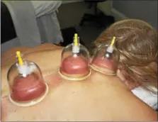  ??  ?? Plastic suction cups line the back of Patti Coates during her massage session at the Center Massage studio in Royersford. Small plastic cups are used with a pump to release tension areas on the skin.