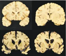  ?? Dr. Ann McKee / Boston University ?? This shows sections from a normal brain (top) and from the brain of former University of Texas player Greg Ploetz (bottom), in stage IV of chronic traumatic encephalop­athy.