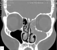  ??  ?? 1 1. CBCT muestra la opacificac­ión del seno maxilar, de las células etmoidales y del seno frontal izquierdo.