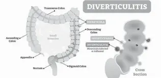  ?? VectorMine / Getty Images / iStockphot­o ?? The risk of being diagnosed with colon cancer after diverticul­itis is substantia­lly higher than would be expected, especially in a person with recurrent symptoms.