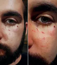  ??  ?? I segni dell’aggression­e sul volto di Marco, uno dei due giovani aggrediti ieri a Pisa