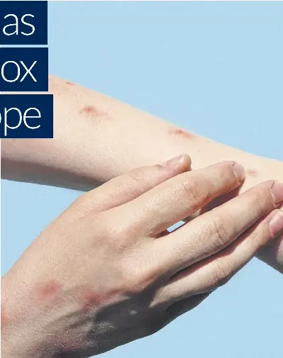 UK on high alert as new strain of mpox detected in Europe - PressReader