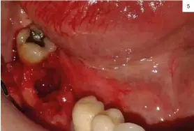  ??  ?? 5 Figura 5: Imagen del alveolo tras la extracción de la pieza, dónde observamos la integridad de sus paredes. Figura 6: Imagen de la colocación del biomateria­l de elección, fácil manejo mediante una pinza. Figura 7: Imagen que muestra el relleno del...