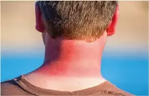  ??  ?? PAIN IN NECK: Sunburn is agonising and dangerous