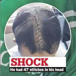 ??  ?? SHOCK He had 47 stitches in his head