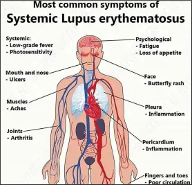  ??  ?? Lupus’ symptoms may mimic other illnesses.