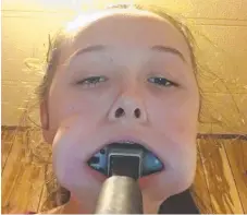  ??  ?? Kaley, 14, got this hammer stuck in her mouth after a dare.