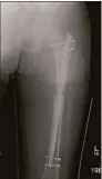  ?? Contribute­d photo ?? A healed femur after the leg-lengthenin­g rod has been inserted.