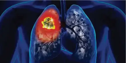  ??  ?? Lung cancer is the leading cause of cancer death globally, causing 1.7 million deaths a year.