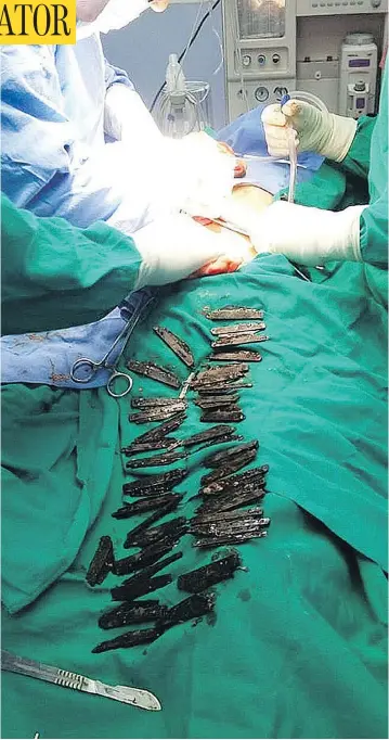  ?? PHOTOS: COURTESY AMRITSAR CORPORATE HOSPITAL ?? Indian surgeons extracted 40 knives — some folded, some not — from the stomach of a patient who lived to tell the tale.