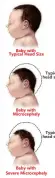  ?? Baby with Microcepha­ly ?? Typical head size
Baby with Severe Microcepha­ly Typical head size