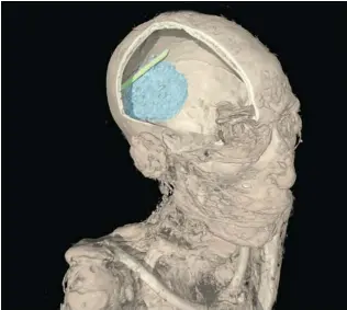  ?? BRITISH MUSEUM ?? A computer- generated CT scan shows evidence of a tool mistakenly left in the skull during the mummificat­ion process. The British Museum is set to display its findings at a new exhibition.