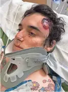  ?? C.J. MONTANO ?? “They shot me directly in the face,” says C.J. Montano, 24, a former Marine who was wounded after attending a demonstrat­ion May 30 in Los Angeles.