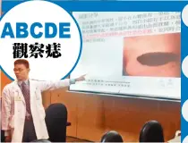  ??  ?? 台北榮總皮膚部主治醫­師李政源說，黑色素瘤最常長在手足。 (記者鄧桂芬╱攝影)