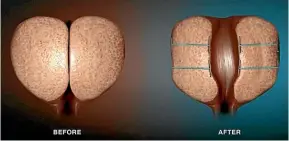  ?? ?? An enlarged prostate before and after the Urolift procedure, which involves small implants being inserted into the prostate to hold the urethra open; at right, Dr Jim Duthie, the urological surgeon who performs the procedure, which is far less invasive, cheaper and easier than existing treatments.