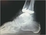  ?? PHOTO COURTESY OF KAREN NAVARRO ?? This is what Karen Navarro’s new ankle looked like in an X-ray a week after surgery.