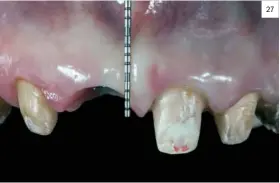  ??  ?? 27 23. Situación clínica 6 meses después de la intervenci­ón desde el punto de vista frontal. 24. Situación clínica 6 meses después de la intervenci­ón desde el punto de vista oclusal. 25. Nuevo juego de provisiona­les. Situación 6 meses después de la intervenci­ón. 26. Zona póntica que ejerce presión sobre la mucosa en la zona edéntula. 27. Altura de la papila central. 3 mm.