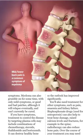  ??  ?? Mid/lower back pain is a common symptom of myeloma