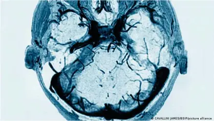  ??  ?? Bei den beobachtet­en Fällen handelt es sich um seltene Thrombosen im Gehirn.