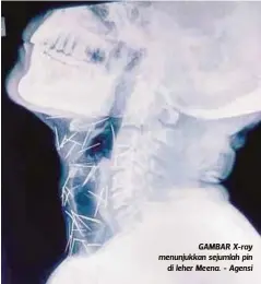  ??  ?? GAMBAR X-ray menunjukka­n sejumlah pin
di leher Meena. - Agensi