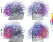  ??  ?? This image shows brain activity in a patient before, top row, and after vagus nerve stimulatio­n. Warmer colours indicate an increase of connectivi­ty.