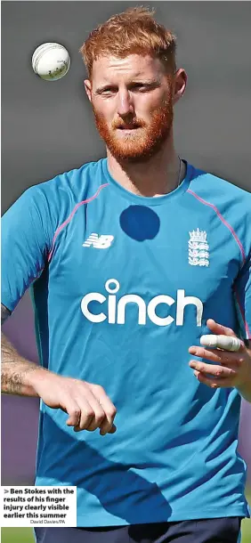  ?? David Davies/PA ?? > Ben Stokes with the results of his finger injury clearly visible earlier this summer