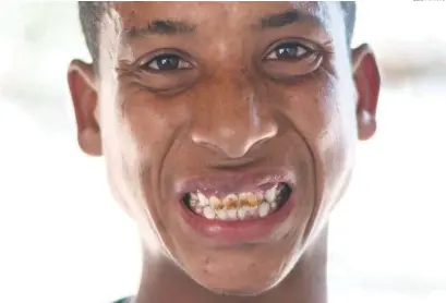  ?? EDDY VITTINI ?? Alex Félix, un pescador de 19 años residente en Barreras, Azua, con signos de fluorosis dental.