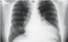  ?? GETTY IMAGES ?? Lung cancer remains the deadliest cancer in the United States, claiming an estimated 130,000 lives this year. In people who receive free, annual screening with CT scans, more tumors are discovered at earlier stages when they are more treatable – and more survivable.